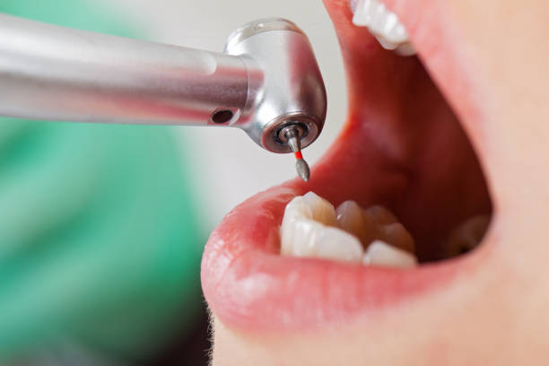 Best Emergency Dentist for Knocked-Out Tooth in Marysville, MI